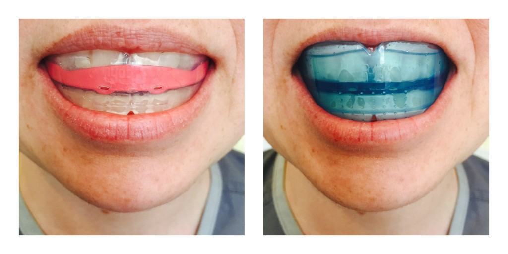 Myobraces Collage